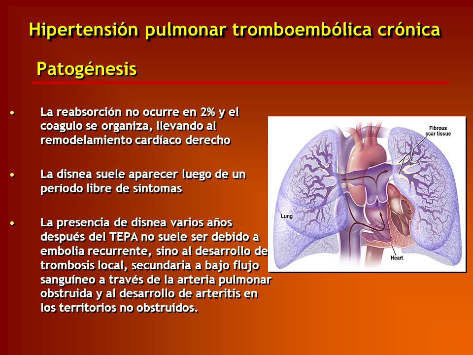 Tratamiento para la hipertensión pulmonar tromboembólica crónica